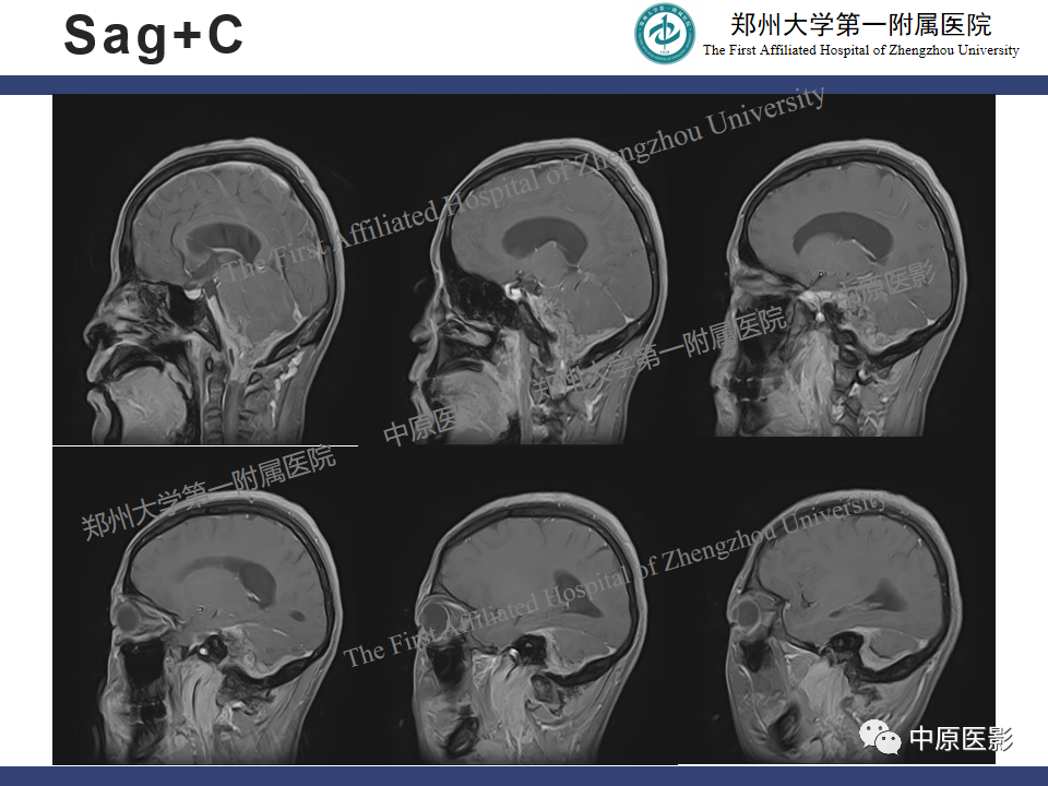 影像PPT - 【病例】桥小脑角区脑膜瘤1例MR-8