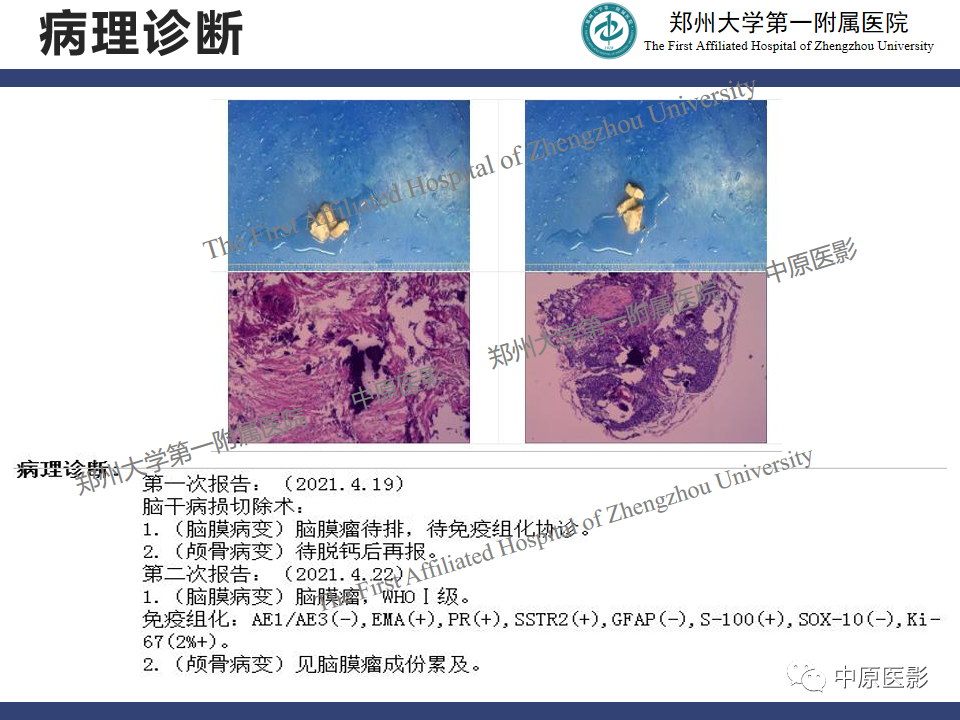 影像PPT - 【病例】桥小脑角区脑膜瘤1例MR-12