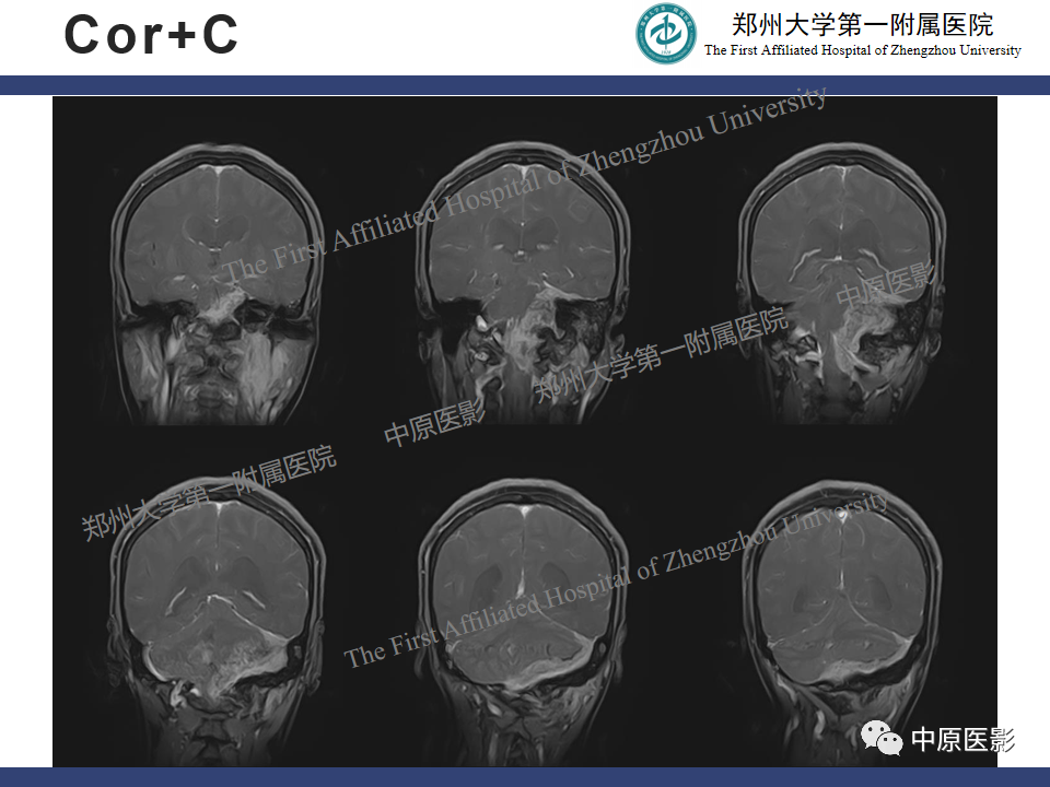 影像PPT - 【病例】桥小脑角区脑膜瘤1例MR-9