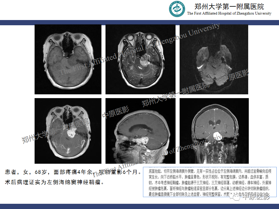 影像PPT - 【病例】桥小脑角区脑膜瘤1例MR-19