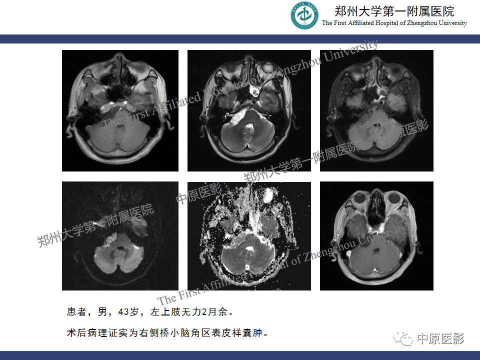 影像PPT - 【病例】桥小脑角区脑膜瘤1例MR-21
