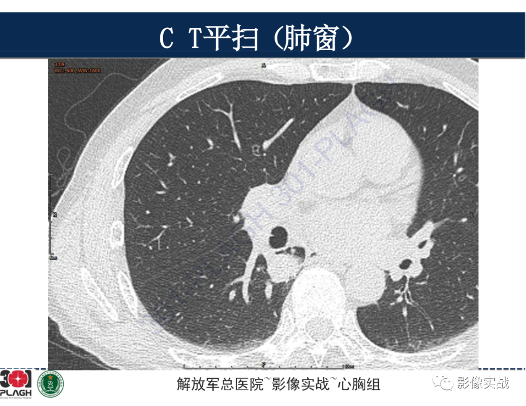 影像PPT - 【病例】肺浸润性腺癌1例CT-5