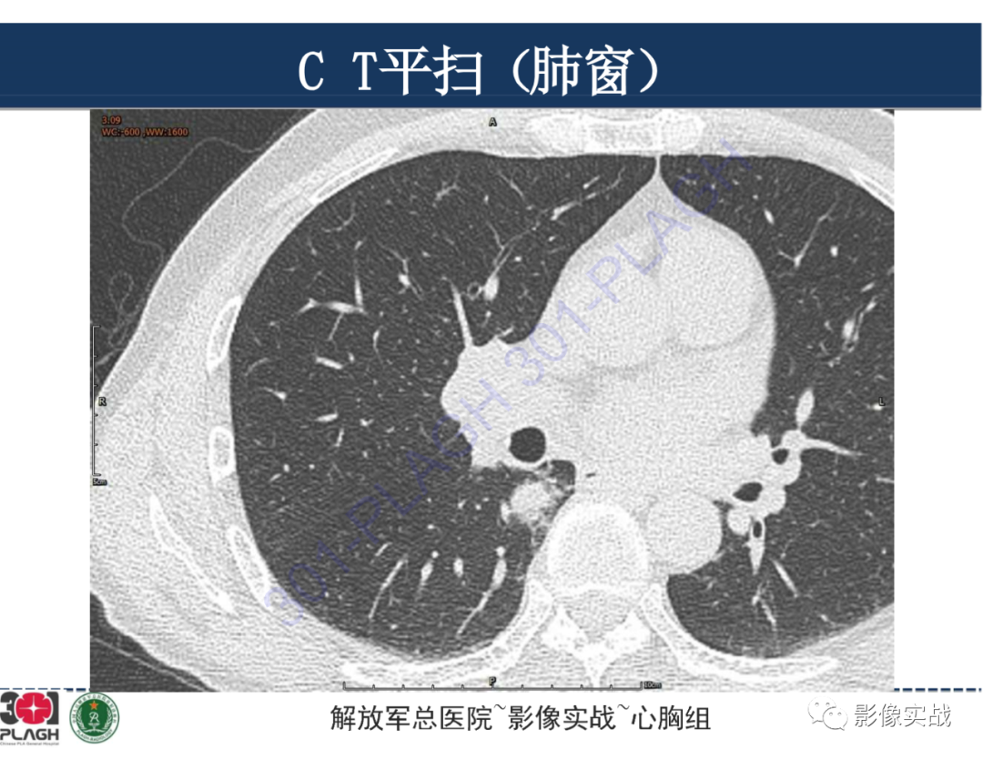 影像PPT - 【病例】肺浸润性腺癌1例CT-4