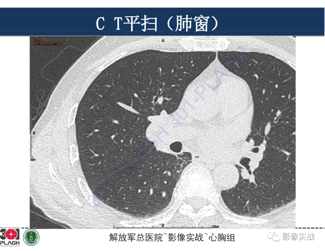 影像PPT - 【病例】肺浸润性腺癌1例CT-3