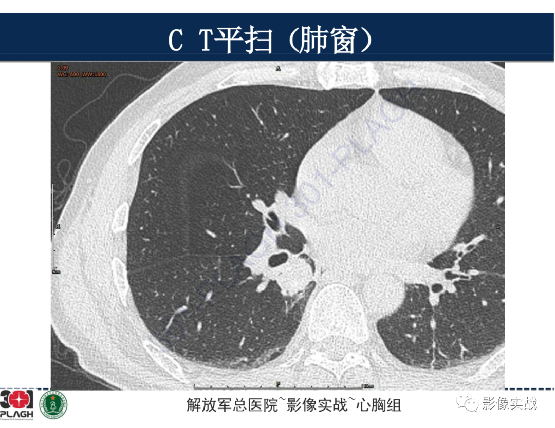影像PPT - 【病例】肺浸润性腺癌1例CT-7