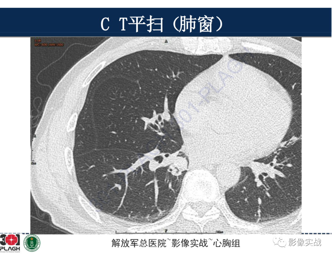 影像PPT - 【病例】肺浸润性腺癌1例CT-8