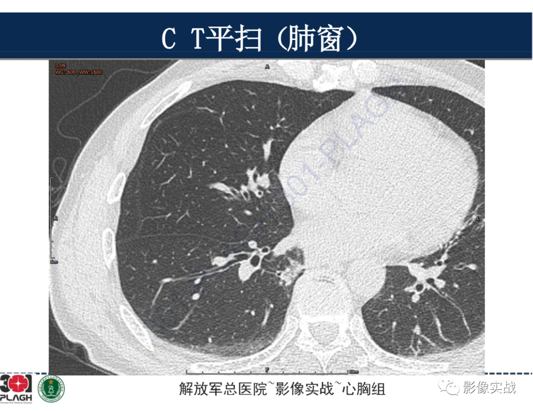 影像PPT - 【病例】肺浸润性腺癌1例CT-9