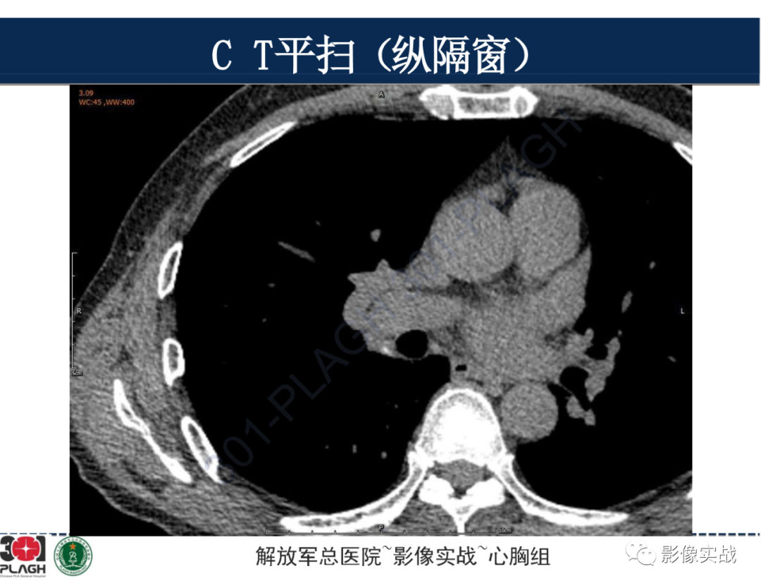 影像PPT - 【病例】肺浸润性腺癌1例CT-10