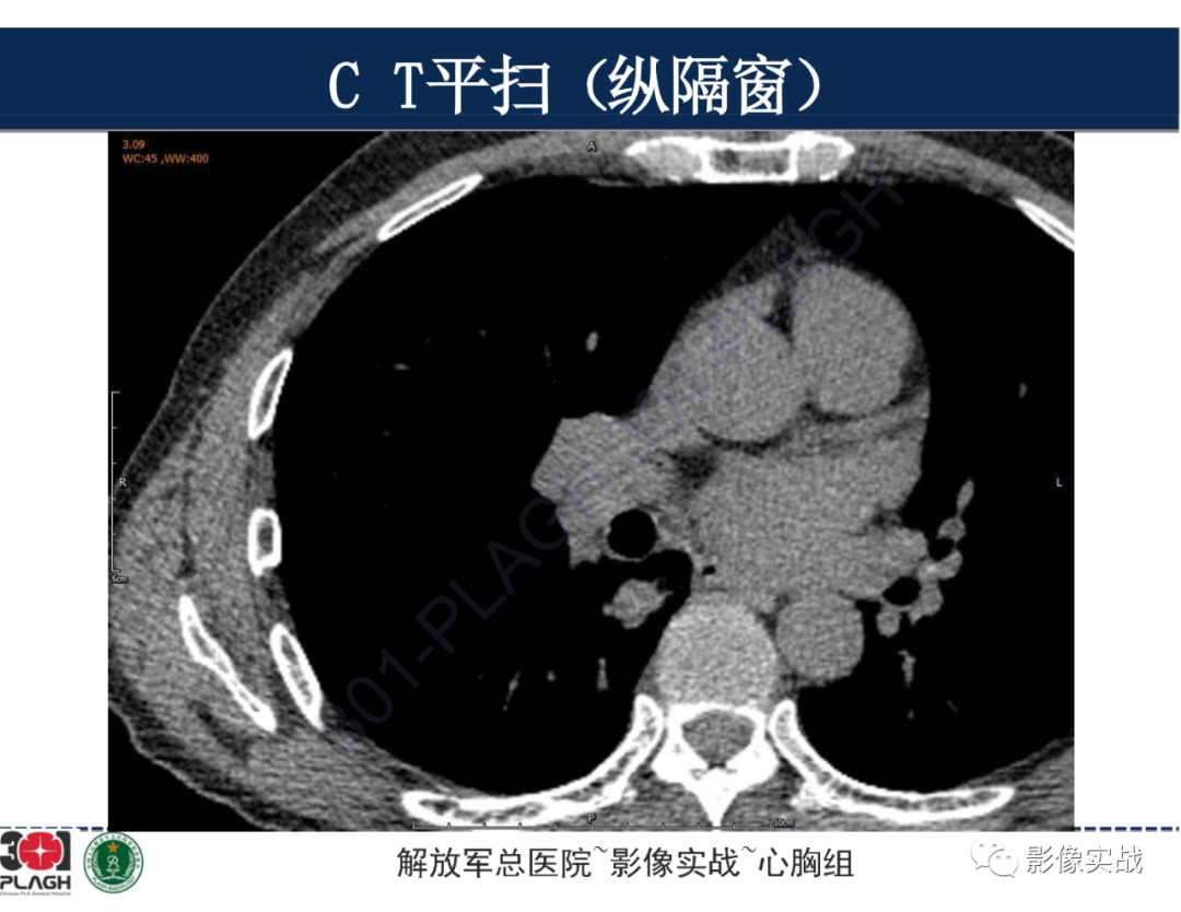 影像PPT - 【病例】肺浸润性腺癌1例CT-11