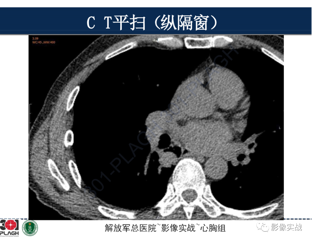 影像PPT - 【病例】肺浸润性腺癌1例CT-12