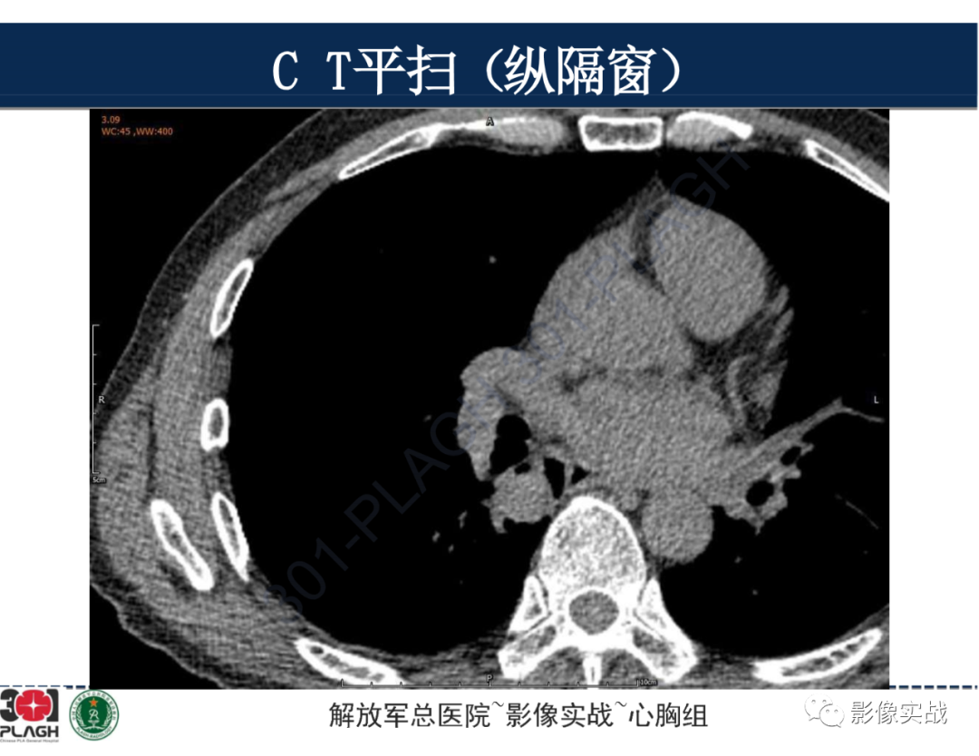 影像PPT - 【病例】肺浸润性腺癌1例CT-13