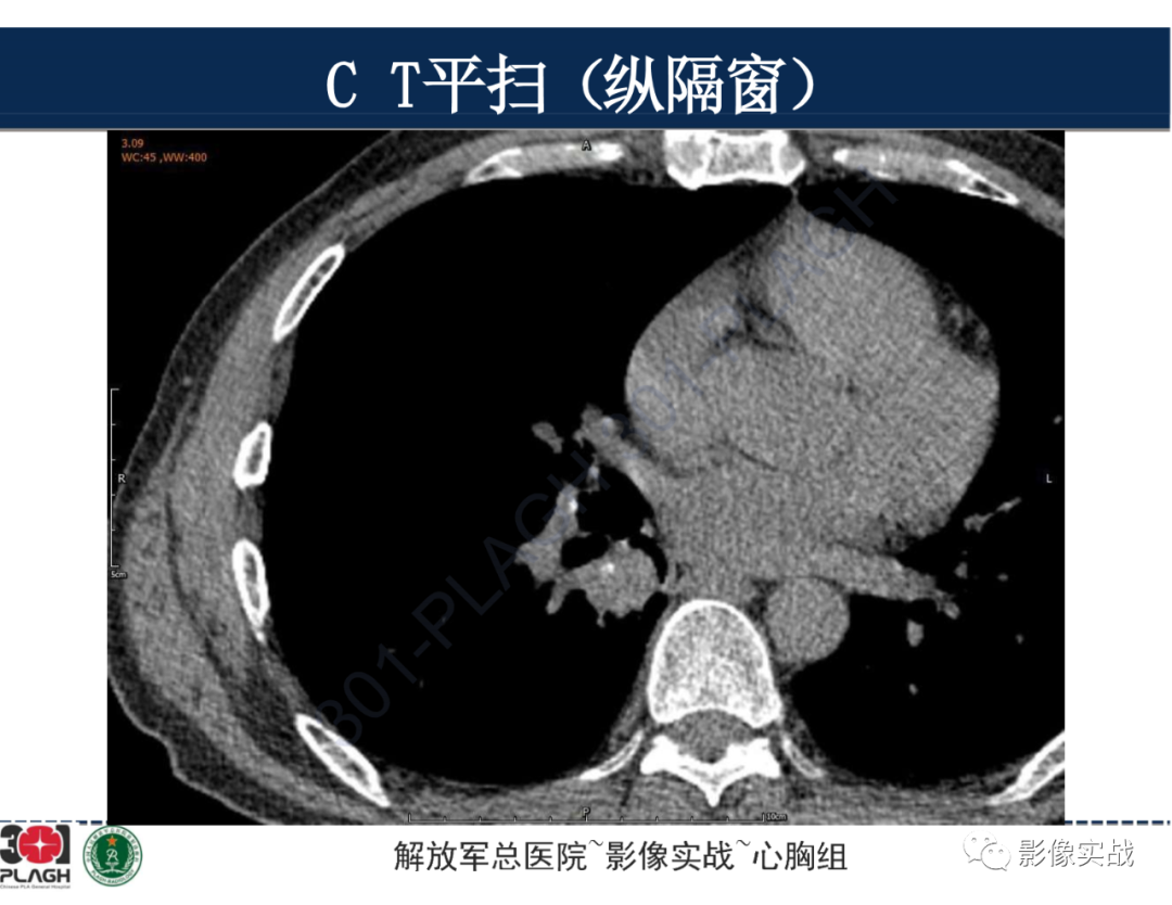 影像PPT - 【病例】肺浸润性腺癌1例CT-14
