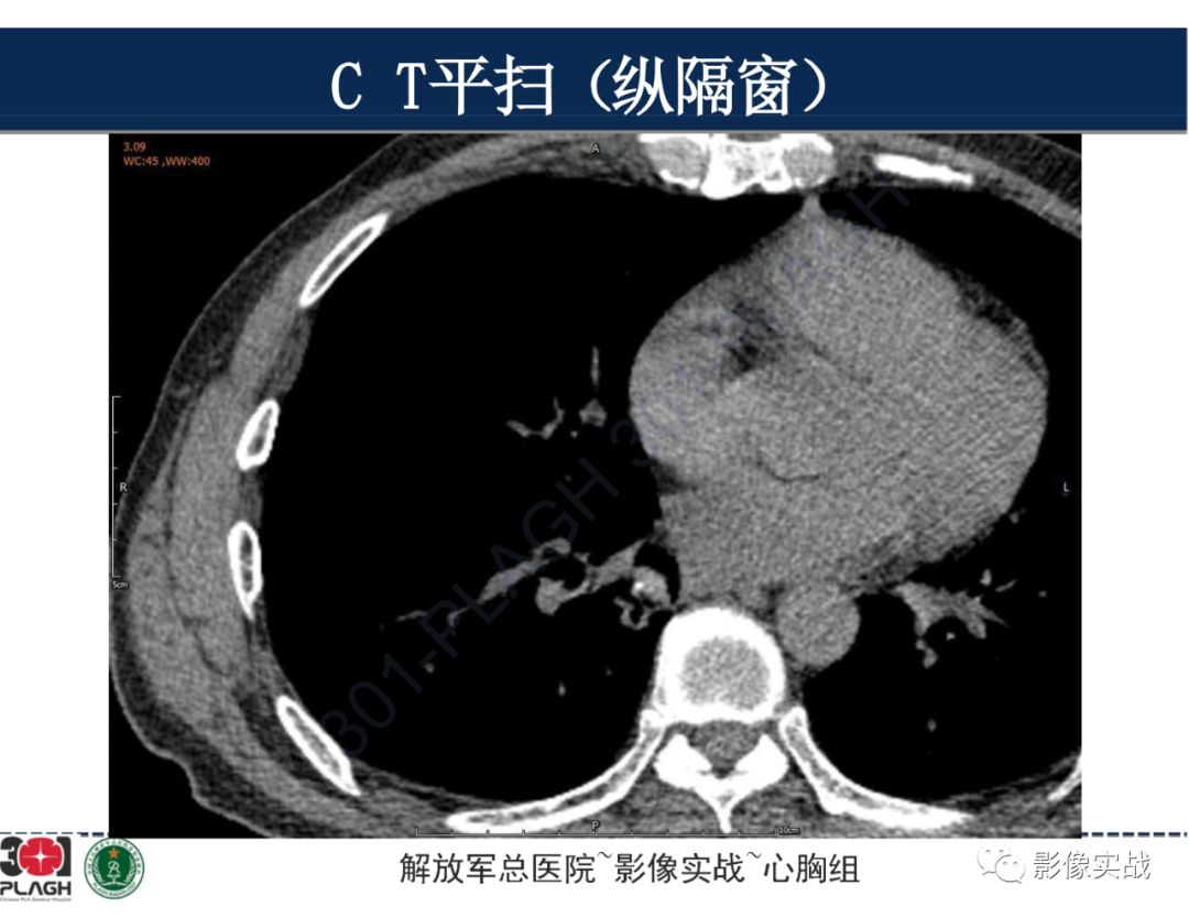 影像PPT - 【病例】肺浸润性腺癌1例CT-15