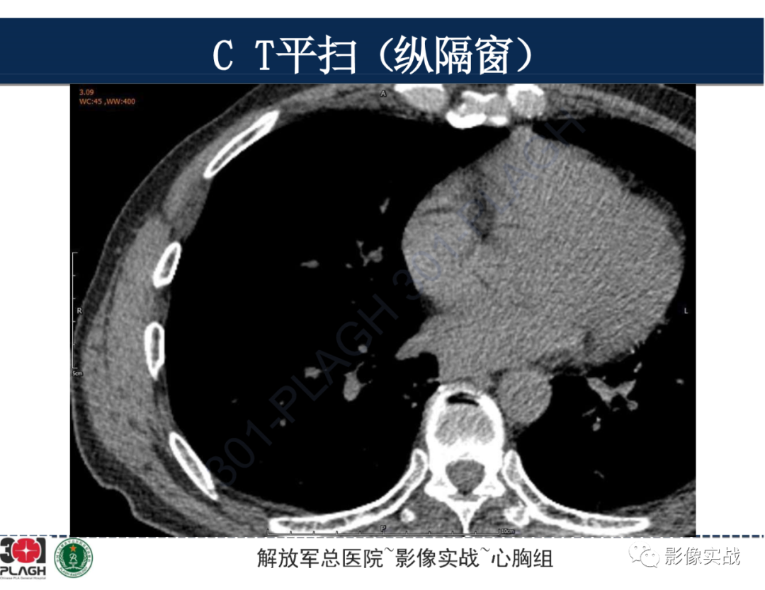 影像PPT - 【病例】肺浸润性腺癌1例CT-16