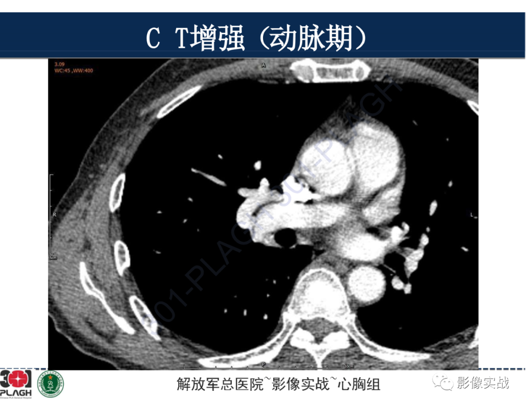 影像PPT - 【病例】肺浸润性腺癌1例CT-17