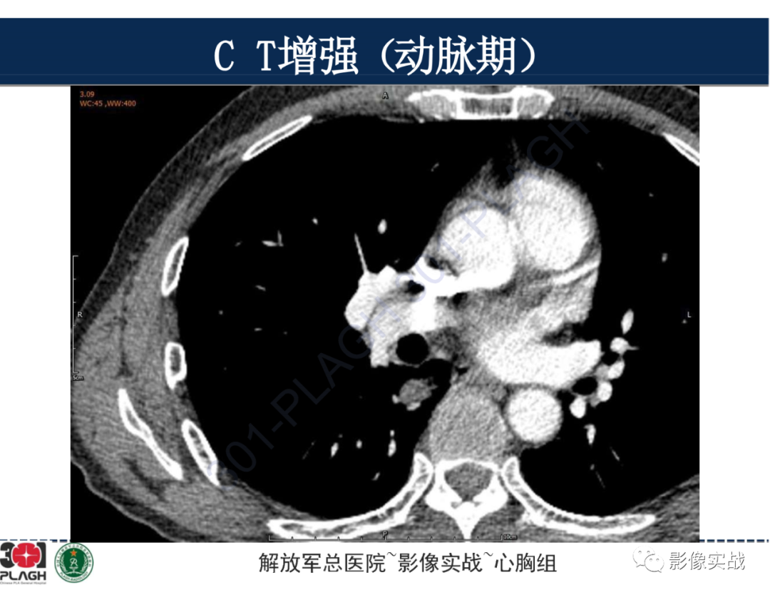 影像PPT - 【病例】肺浸润性腺癌1例CT-18