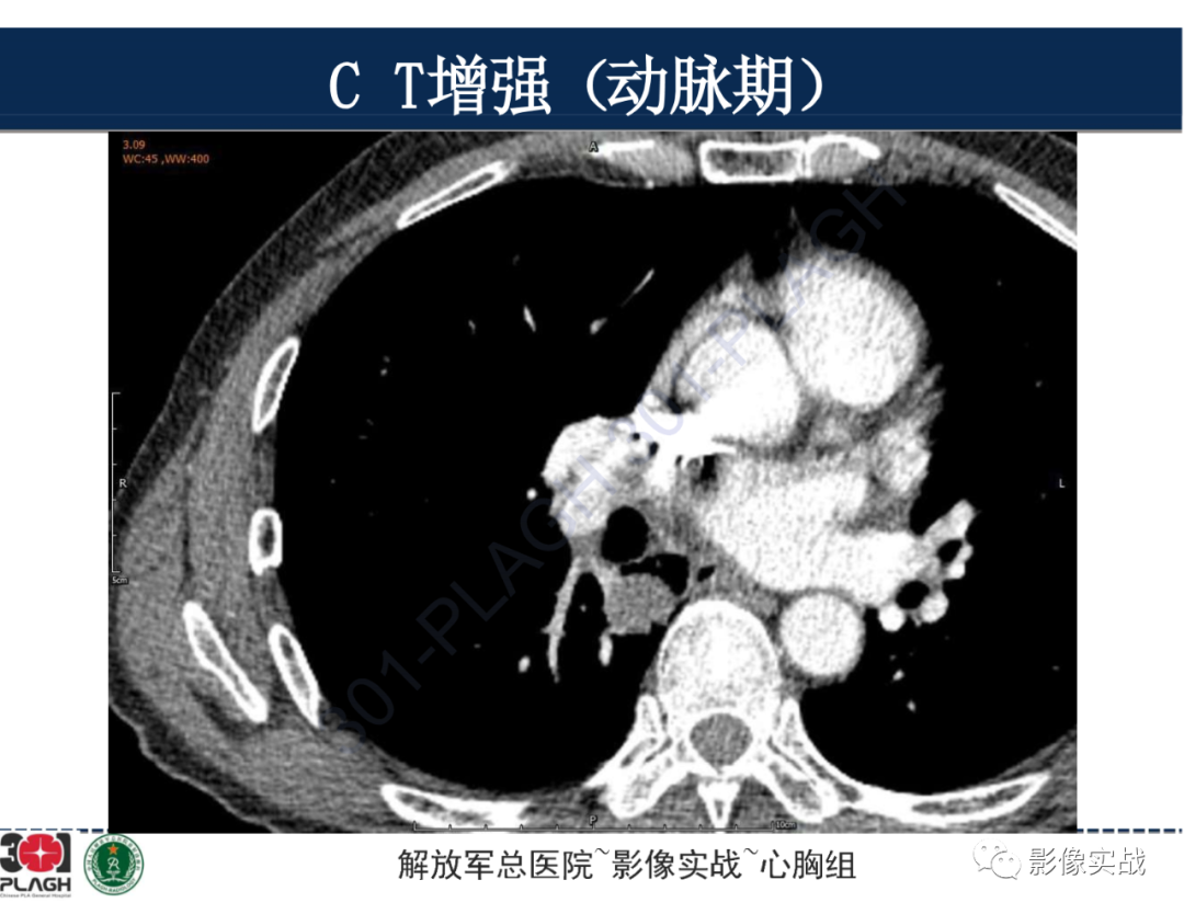 影像PPT - 【病例】肺浸润性腺癌1例CT-19