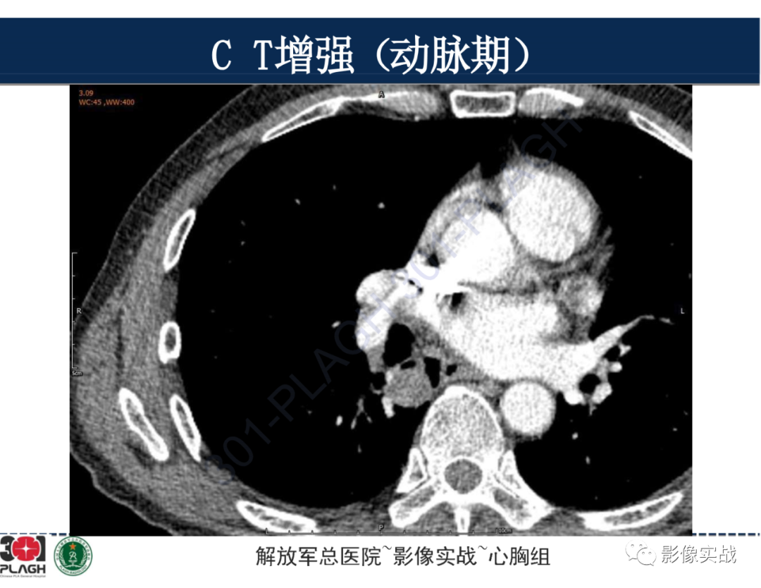 影像PPT - 【病例】肺浸润性腺癌1例CT-20