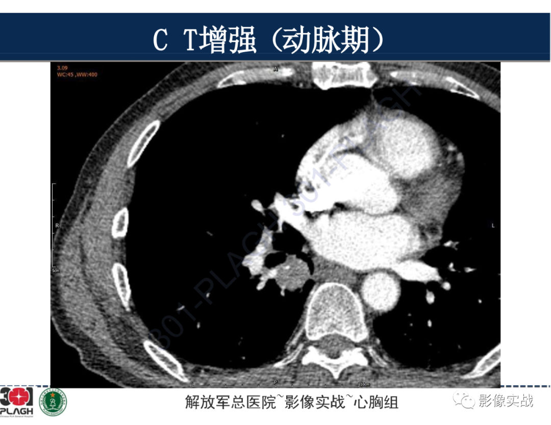 影像PPT - 【病例】肺浸润性腺癌1例CT-21