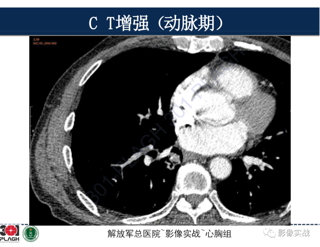 影像PPT - 【病例】肺浸润性腺癌1例CT-22