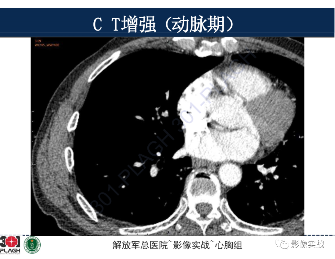 影像PPT - 【病例】肺浸润性腺癌1例CT-23