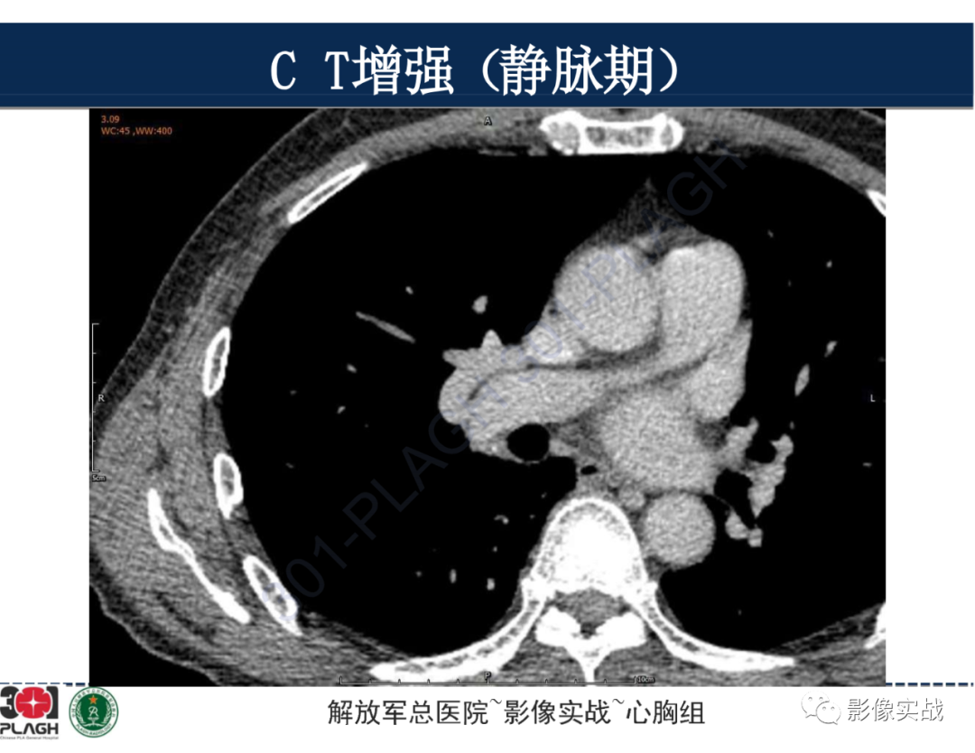 影像PPT - 【病例】肺浸润性腺癌1例CT-24
