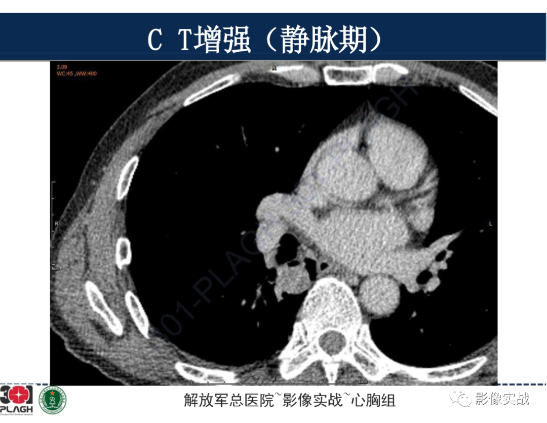 影像PPT - 【病例】肺浸润性腺癌1例CT-26