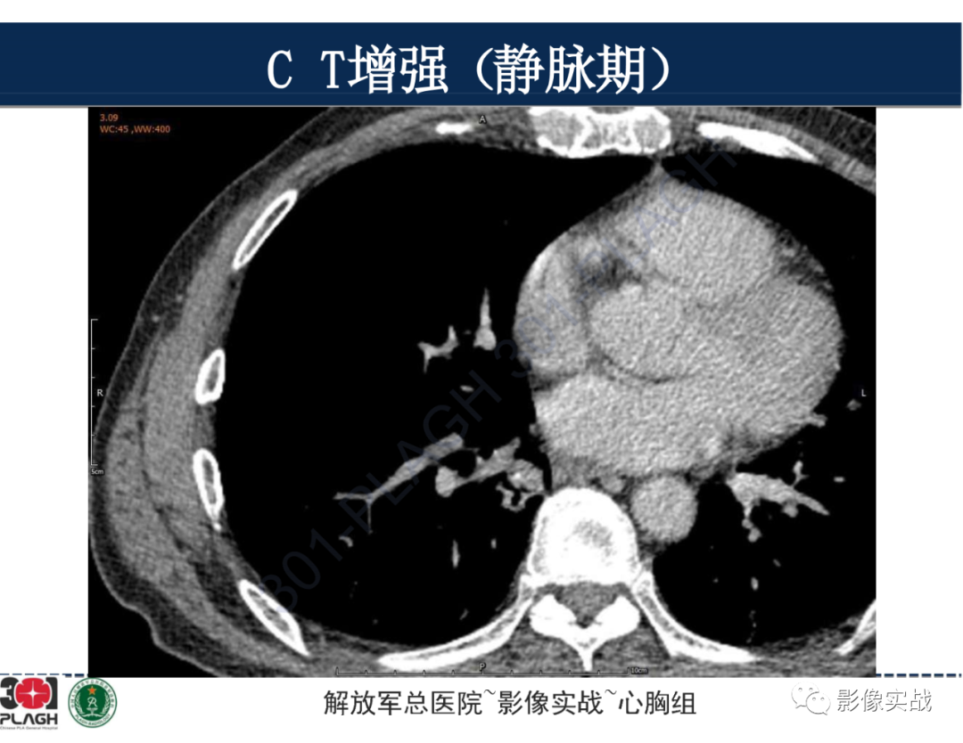 影像PPT - 【病例】肺浸润性腺癌1例CT-28