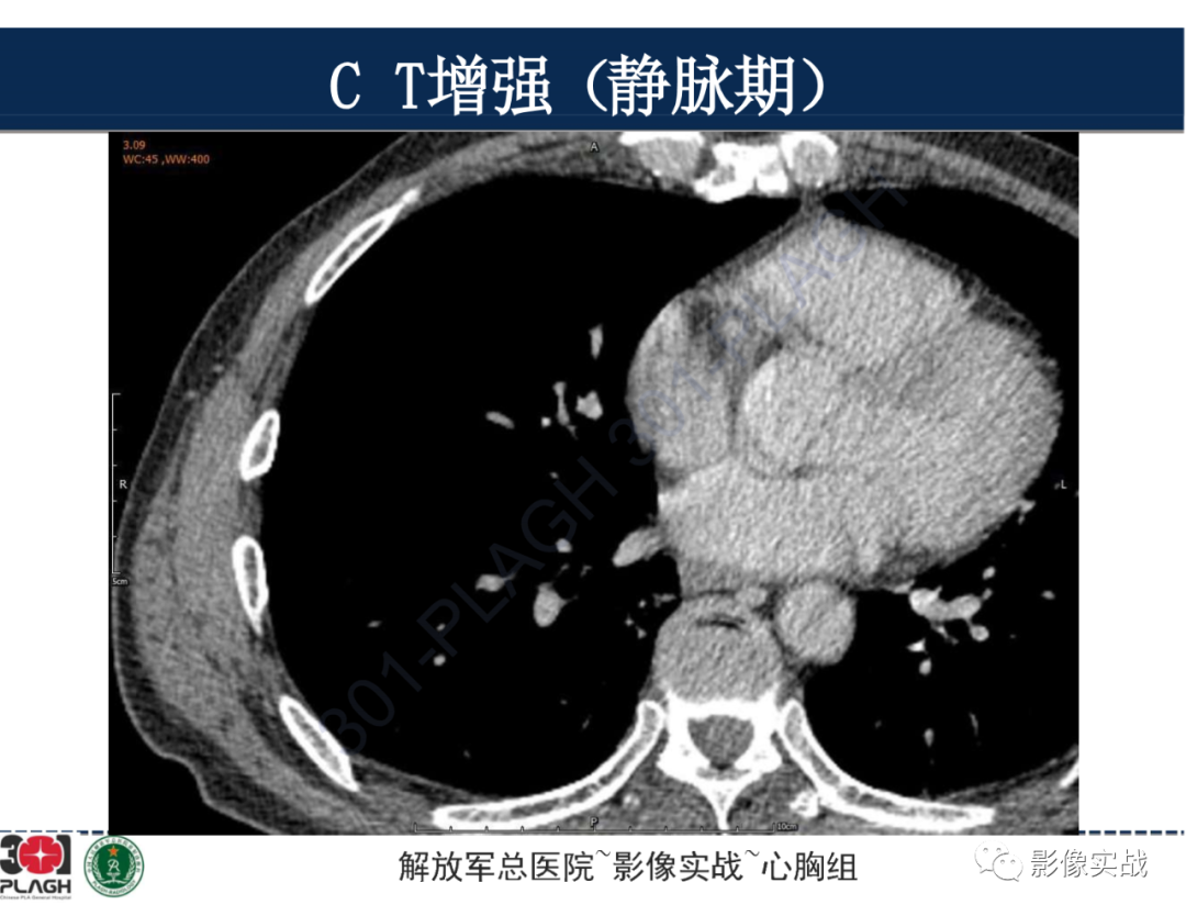 影像PPT - 【病例】肺浸润性腺癌1例CT-29