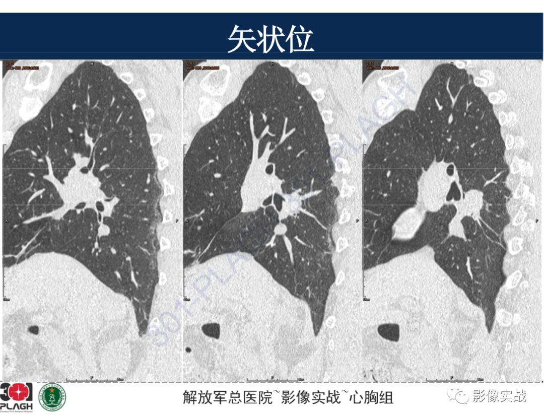 影像PPT - 【病例】肺浸润性腺癌1例CT-30