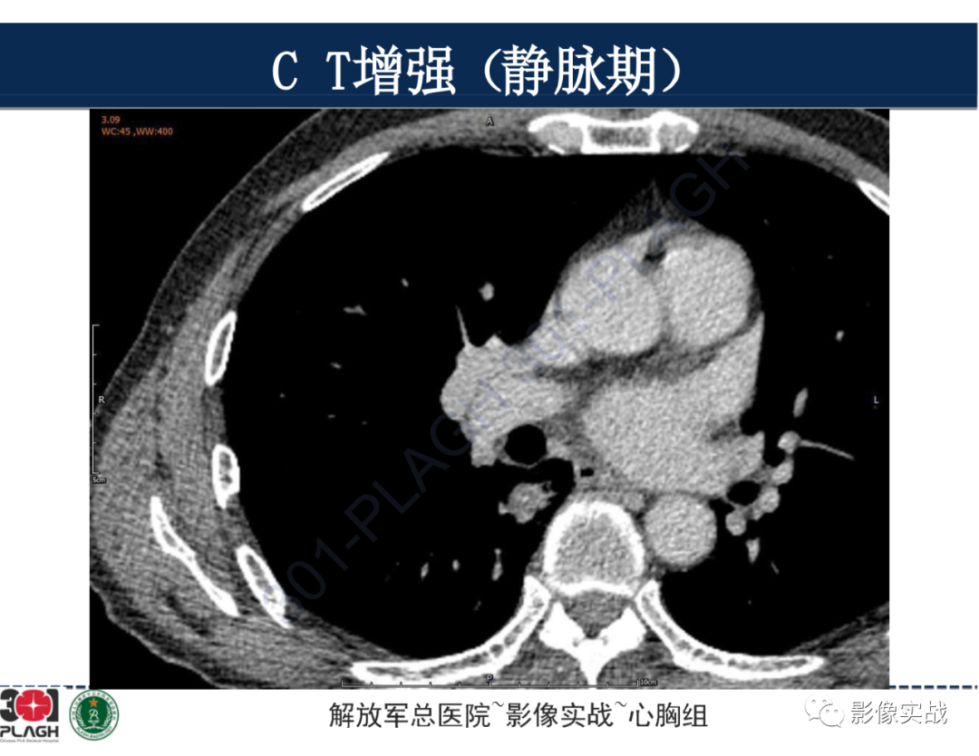 影像PPT - 【病例】肺浸润性腺癌1例CT-25