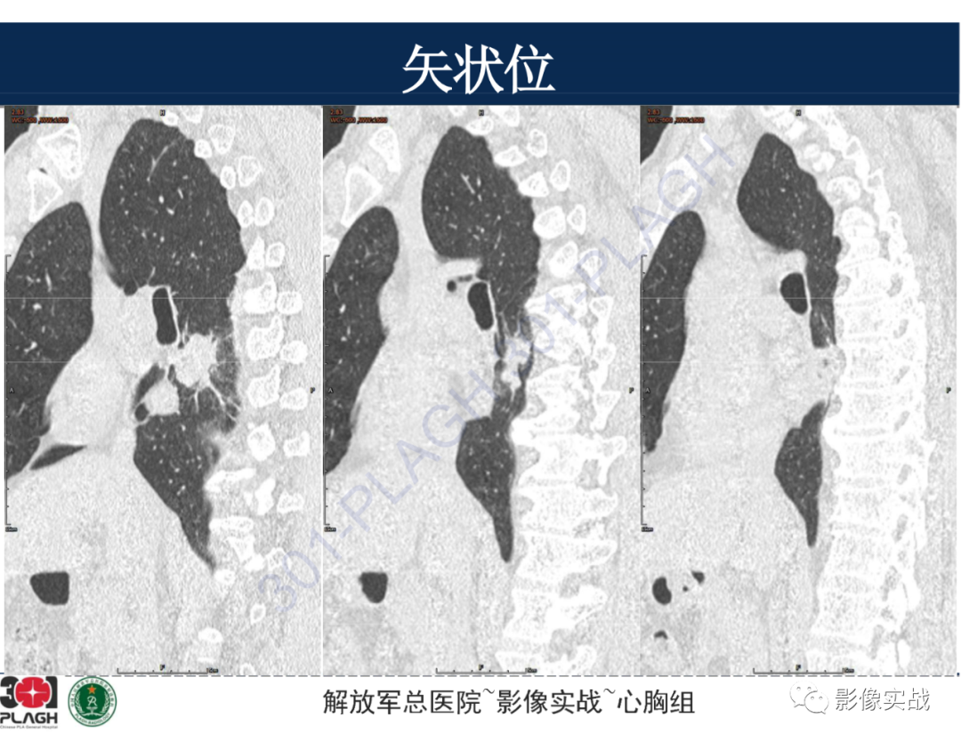 影像PPT - 【病例】肺浸润性腺癌1例CT-31