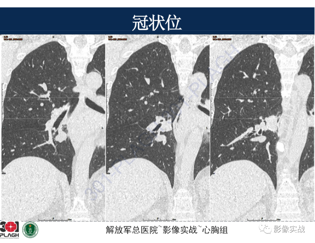 影像PPT - 【病例】肺浸润性腺癌1例CT-32