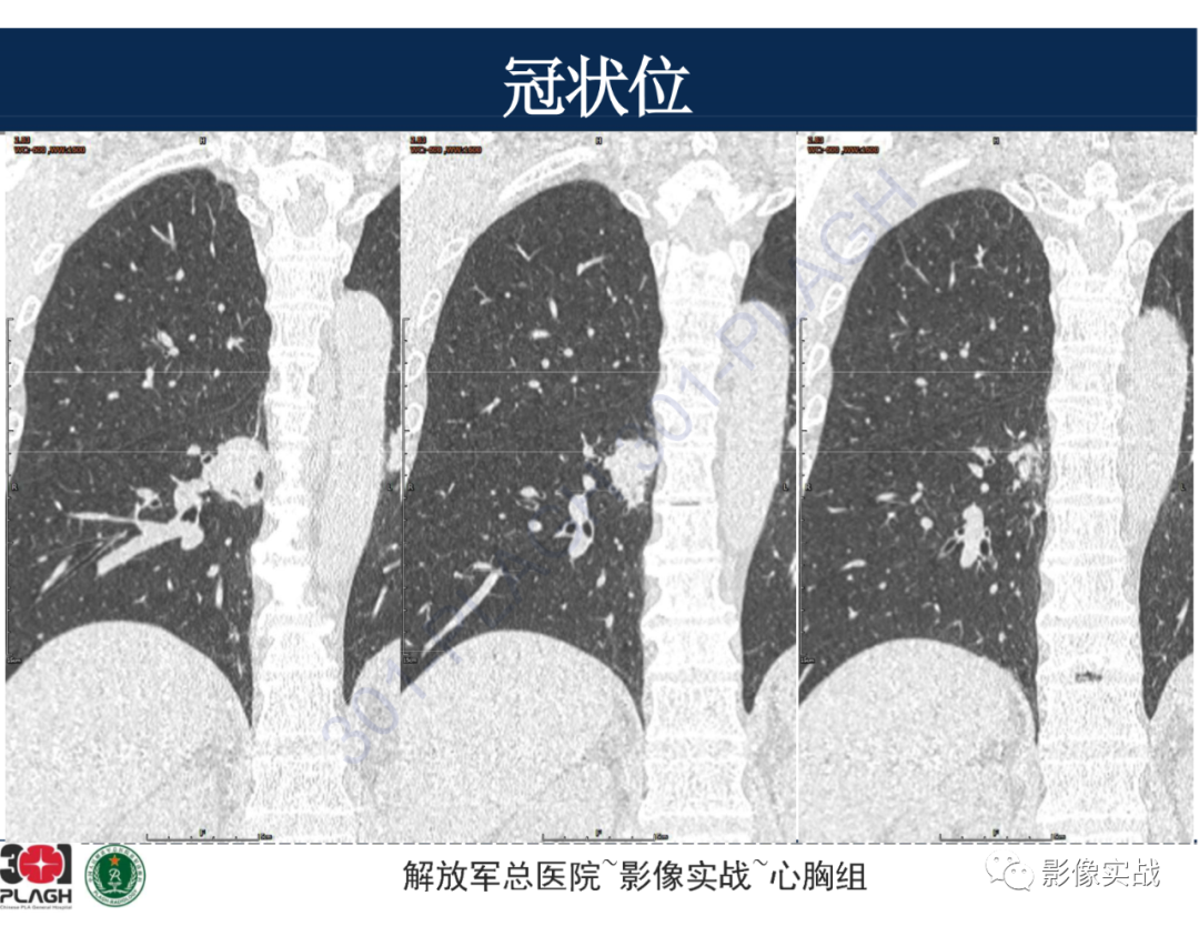 影像PPT - 【病例】肺浸润性腺癌1例CT-33