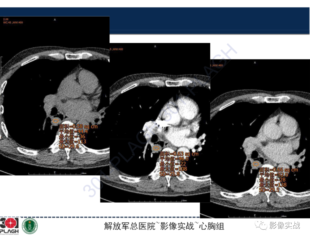影像PPT - 【病例】肺浸润性腺癌1例CT-34