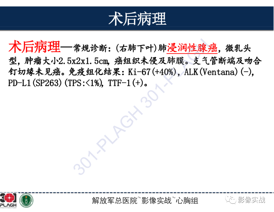 影像PPT - 【病例】肺浸润性腺癌1例CT-36
