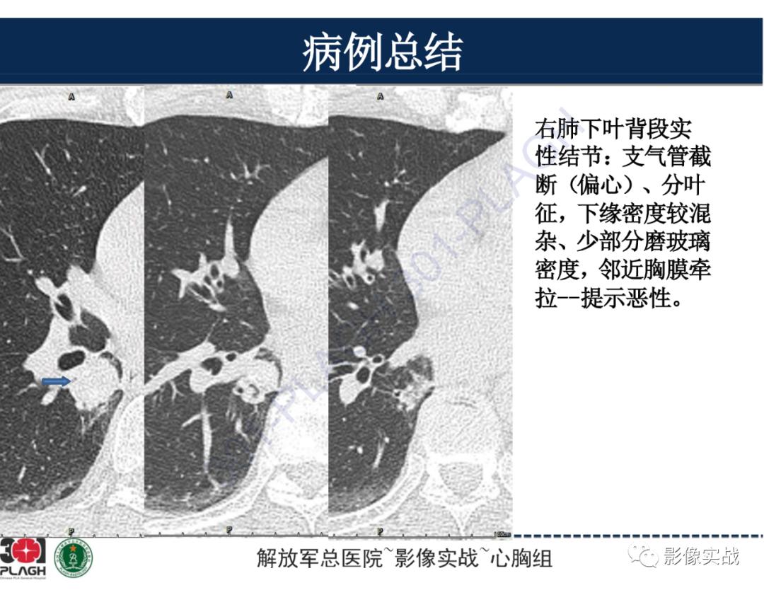 影像PPT - 【病例】肺浸润性腺癌1例CT-37