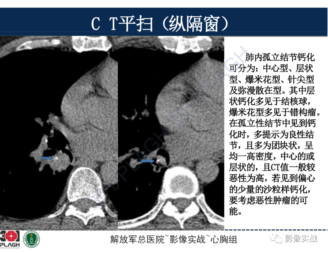 影像PPT - 【病例】肺浸润性腺癌1例CT-38