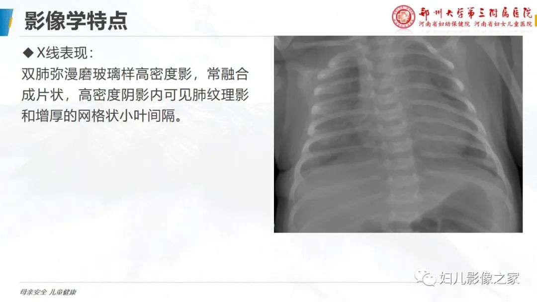 影像PPT - 【PPT】肺泡蛋白沉积症的影像诊断-12