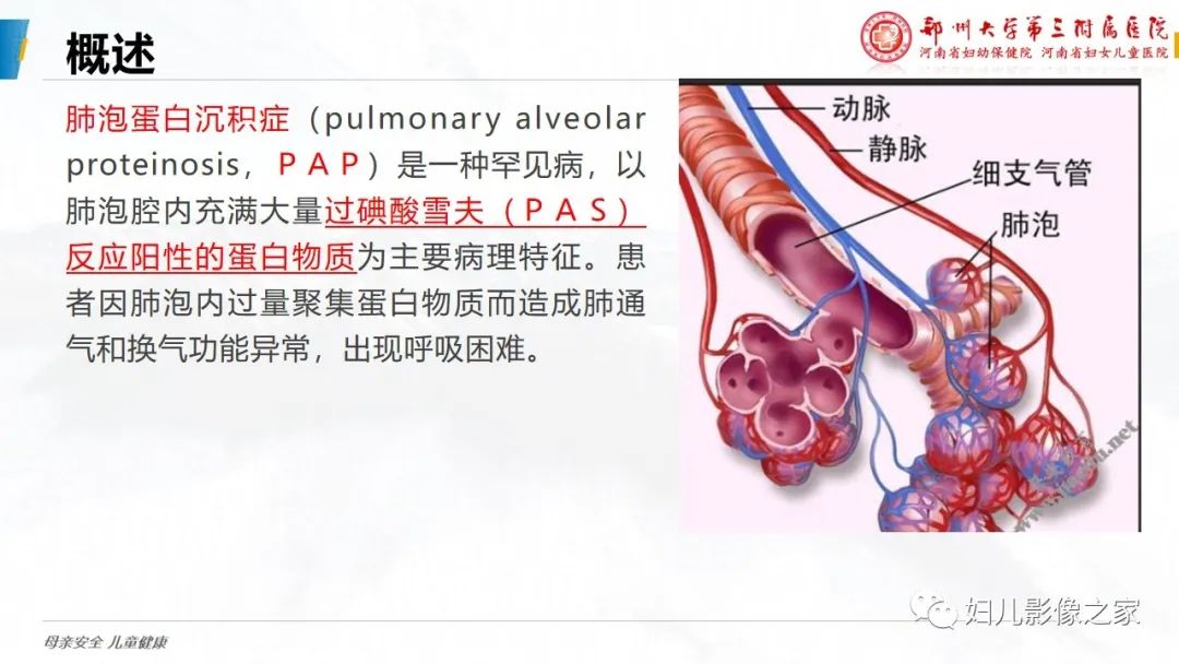 影像PPT - 【PPT】肺泡蛋白沉积症的影像诊断-8