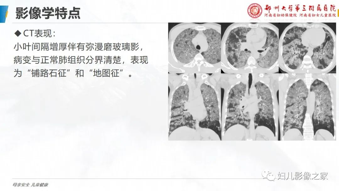 影像PPT - 【PPT】肺泡蛋白沉积症的影像诊断-13