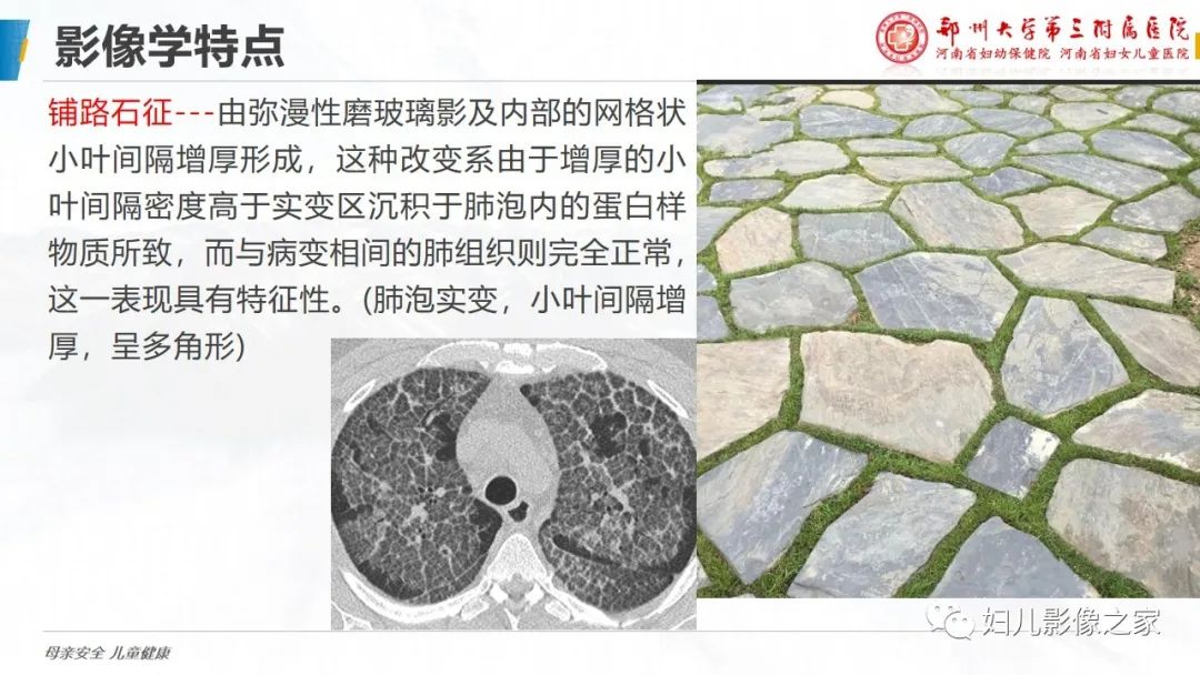 影像PPT - 【PPT】肺泡蛋白沉积症的影像诊断-14