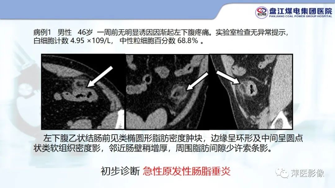 影像PPT - 【PPT】急性肠脂垂炎的CT诊断及鉴别诊断-4