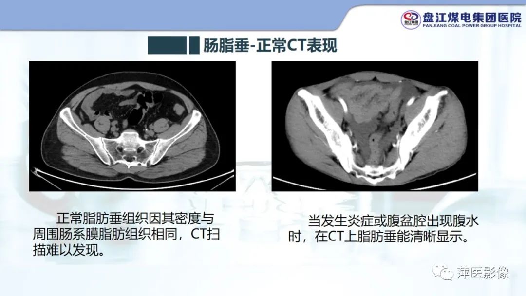 影像PPT - 【PPT】急性肠脂垂炎的CT诊断及鉴别诊断-7