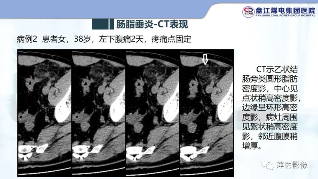 影像PPT - 【PPT】急性肠脂垂炎的CT诊断及鉴别诊断-14