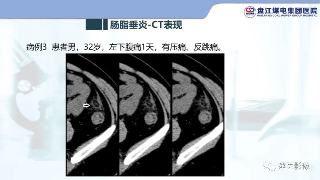 影像PPT - 【PPT】急性肠脂垂炎的CT诊断及鉴别诊断-15