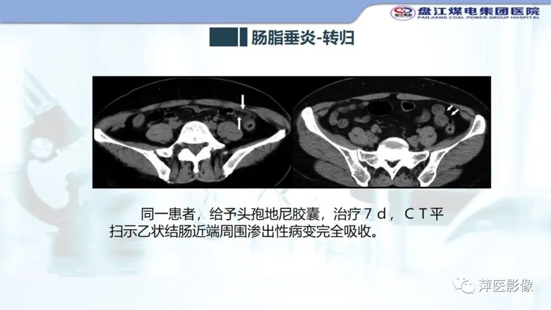 影像PPT - 【PPT】急性肠脂垂炎的CT诊断及鉴别诊断-17