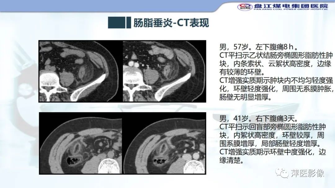 影像PPT - 【PPT】急性肠脂垂炎的CT诊断及鉴别诊断-16