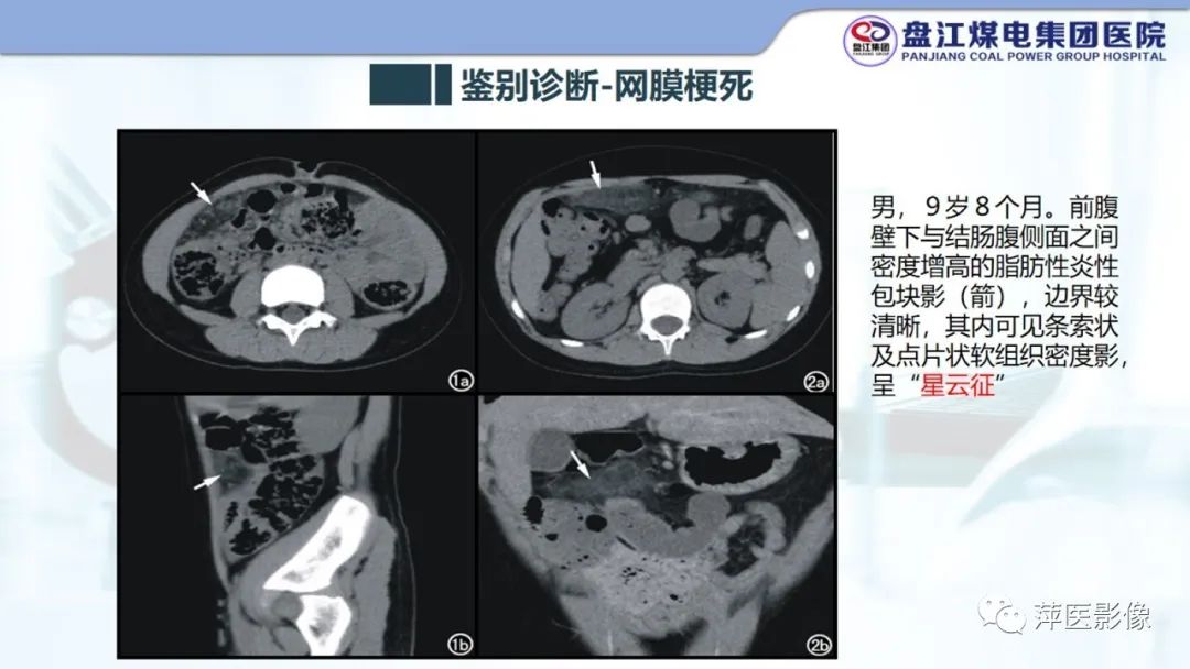 影像PPT - 【PPT】急性肠脂垂炎的CT诊断及鉴别诊断-21
