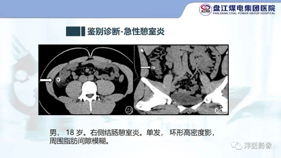 影像PPT - 【PPT】急性肠脂垂炎的CT诊断及鉴别诊断-24